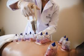 Hijama Cupping Therapy — Back