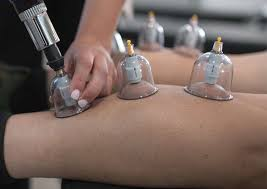 Hijama Cupping Therapy — Leg