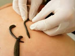 Leech Therapy — 1 Leech